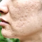 Narben entfernen – damit die Haut wieder glatt wird