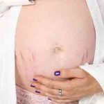 Schön Schwanger &#8211; was tun gegen Schwangerschaftsstreifen?
