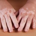 Die Krankheit Vitiligo