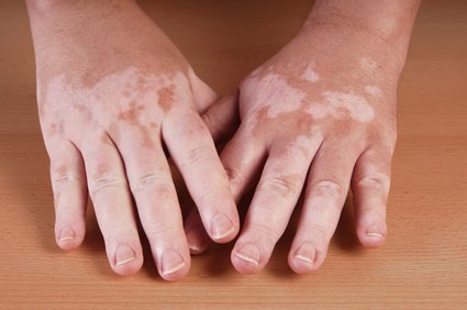 Die Krankheit Vitiligo