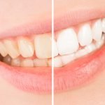 Strahlend weißes Lächeln durch Zahnbleaching